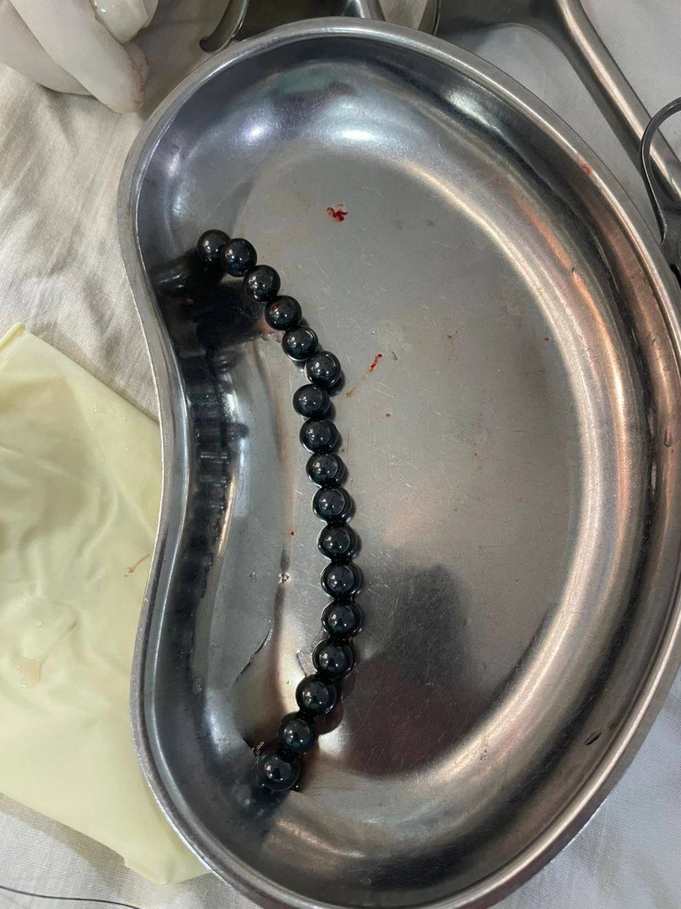 In Osh, a two-year-old child underwent emergency surgery to remove 17 swallowed magnets