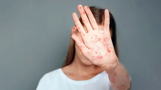 В Казахстане непривитых детей временно отстраняют от школ и детсадов при выявлении кори